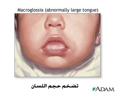 Beckwith-Wiedemann syndrome Beckwith-Wiedemann_syndrome (3).jpg